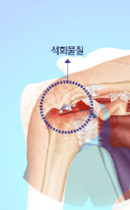 석회성 건염