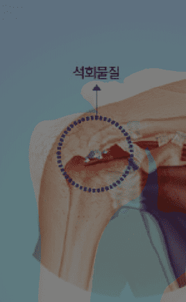 석회성 건염