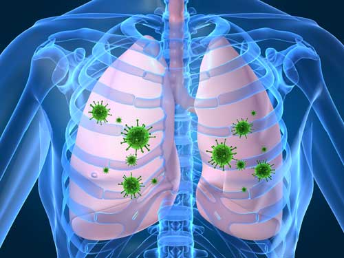 Pneumonia