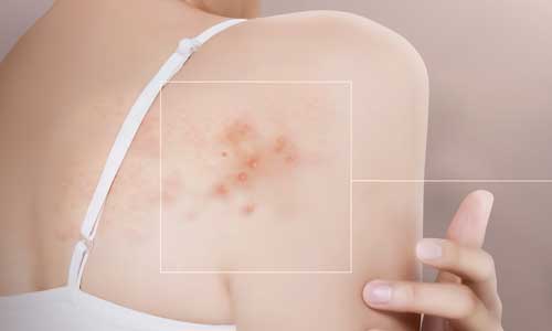 Shingles