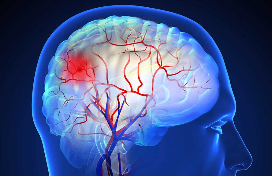 Illustration of blood vessels in the brain