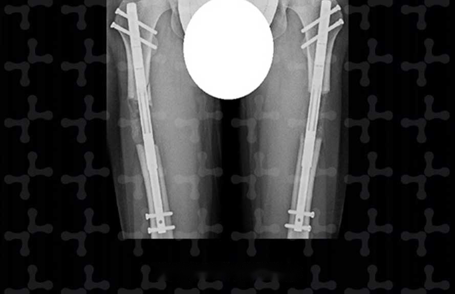 X-ray of thighbones after Ilizarov lengthening