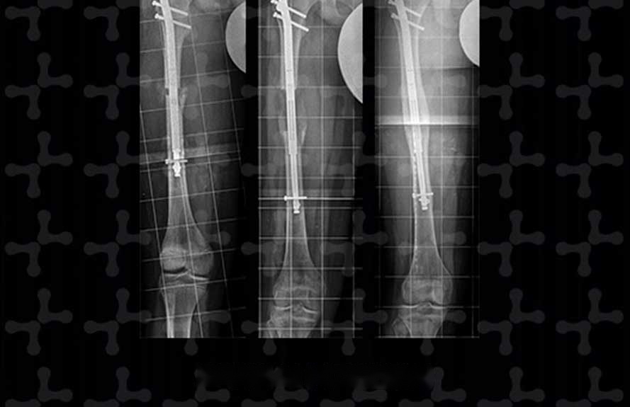 X-rays of leg bones lengthened with the PRECICE 2 internal nail