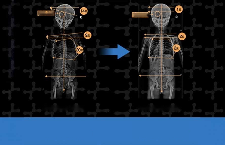 Whole-spine X-rays of a child before and after scoliosis treatment