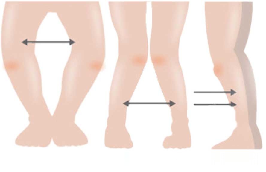 Illustrations of bow legs, knock knees and hyperextended knees