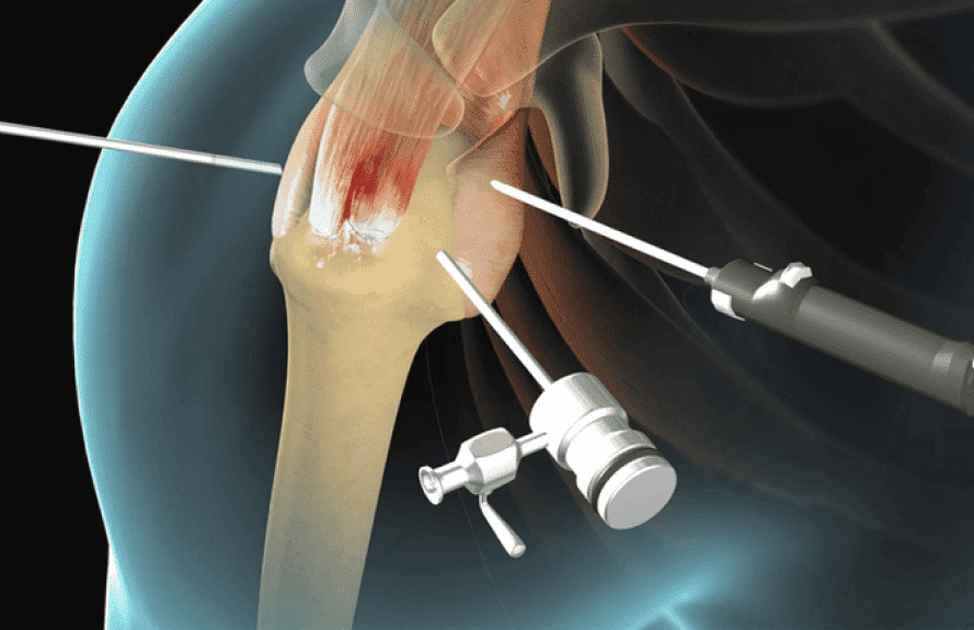 Illustration of arthroscopic shoulder surgery