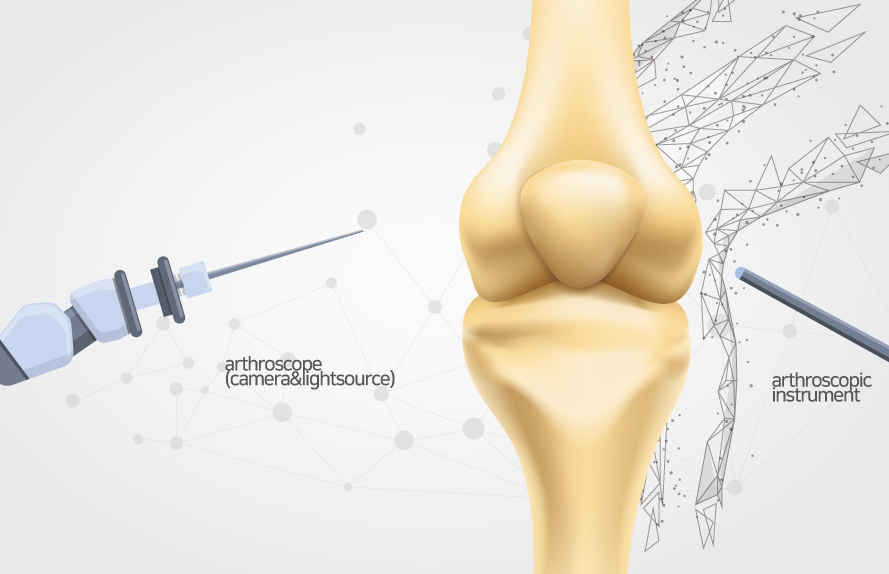 Illustration of knee arthroscopy
