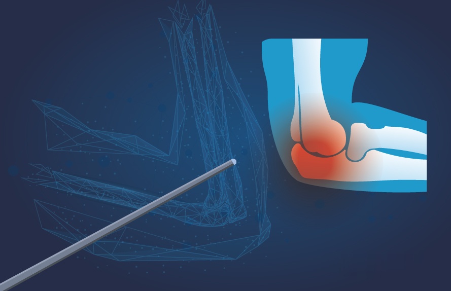 Illustration of tennis elbow