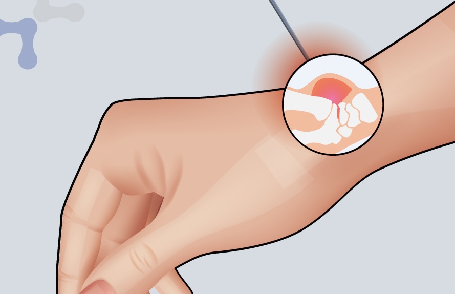 Illustration of a ganglion cyst on the wrist