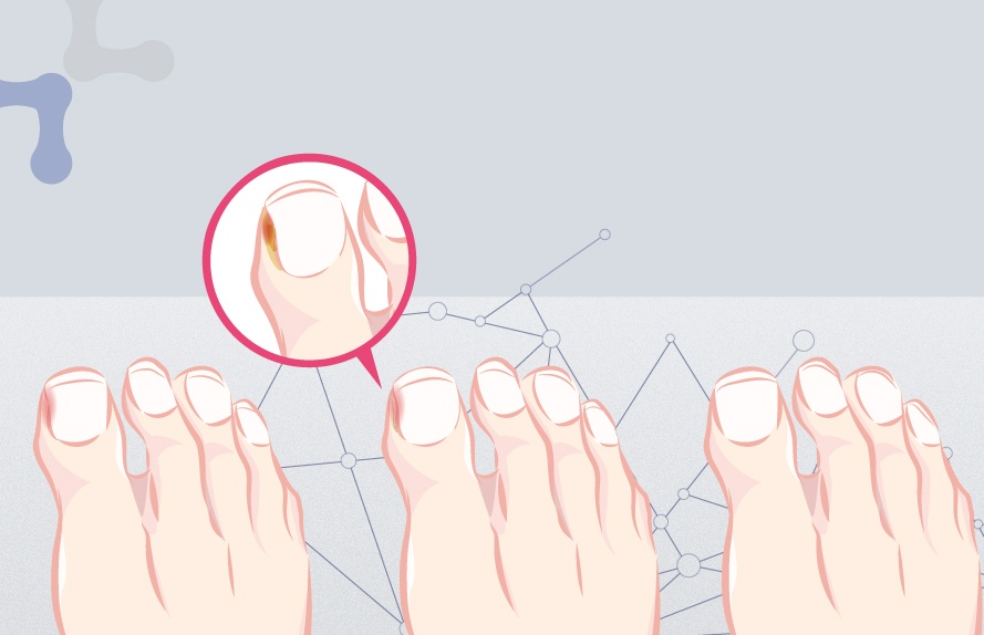 Illustration of an ingrown toenail