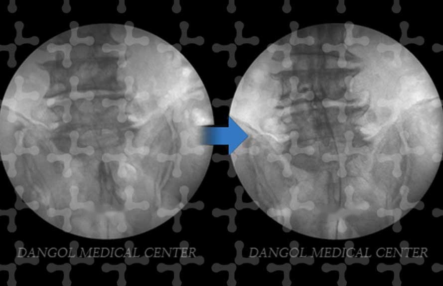 Fluoroscopic images before and after treatment
