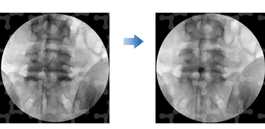 Fluoroscopic images of catheter insertion and balloon dilation