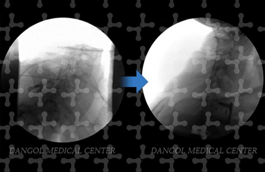 Fluoroscopic images before and after treatment