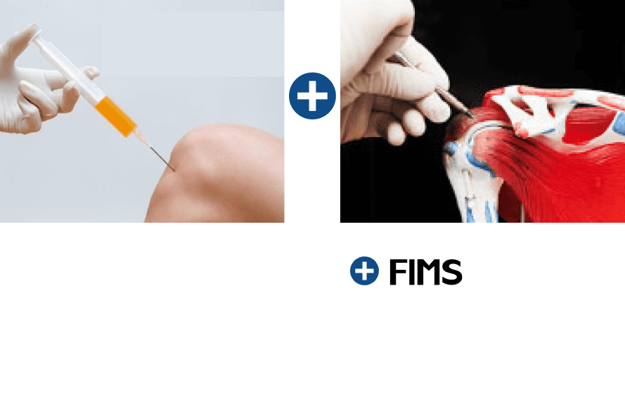 Prolotherapy injection and FIMS treatment of the shoulder