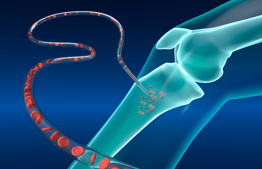 Illustration of a bone marrow injection into the knee