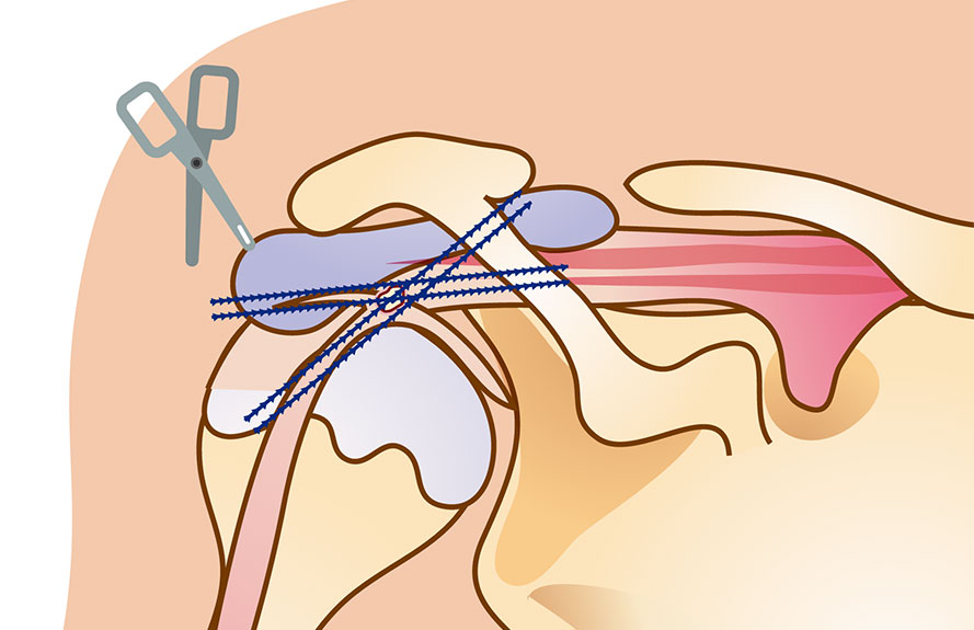 Illustration of sutures placed across a partial rotator cuff tear