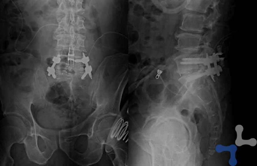 X-ray images of the lumbar spine with spinal instrumentation