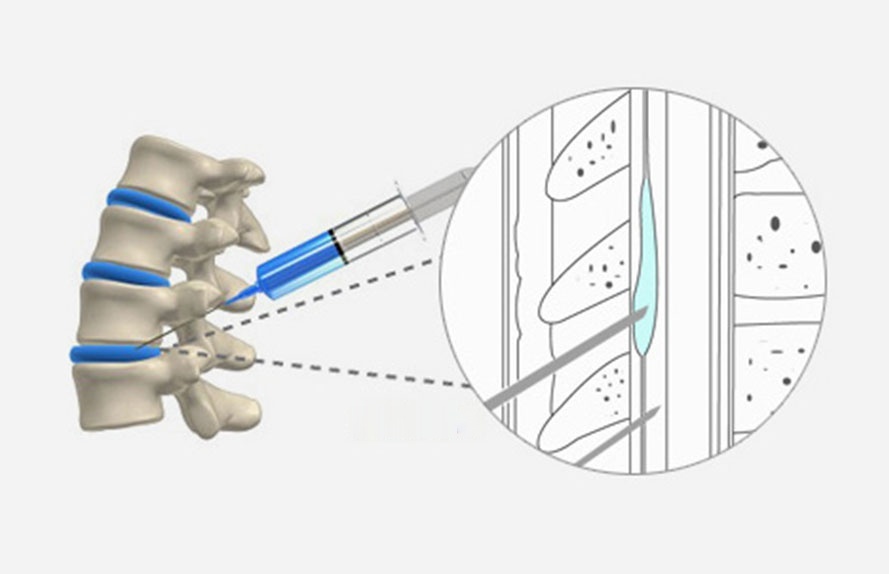 Illustration of an epidural anesthesia needle entering the spine