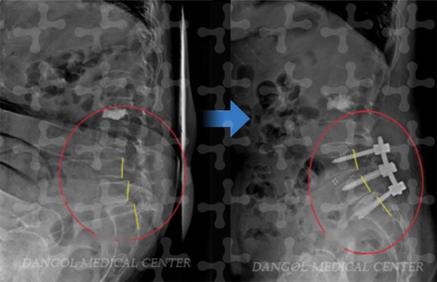 Lumbar X-rays before and after spinal fusion