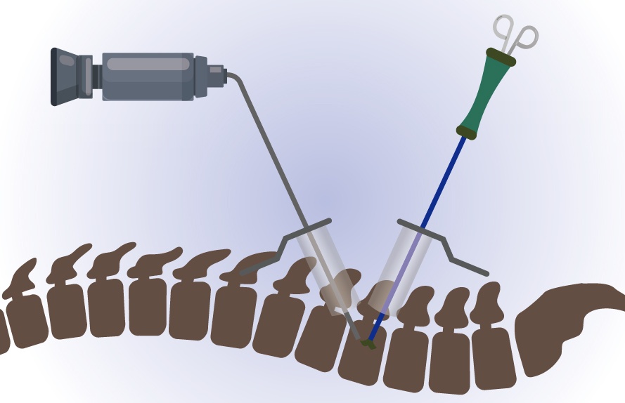 Illustration of biportal endoscopic spine surgery with an endoscope camera and a surgical instrument