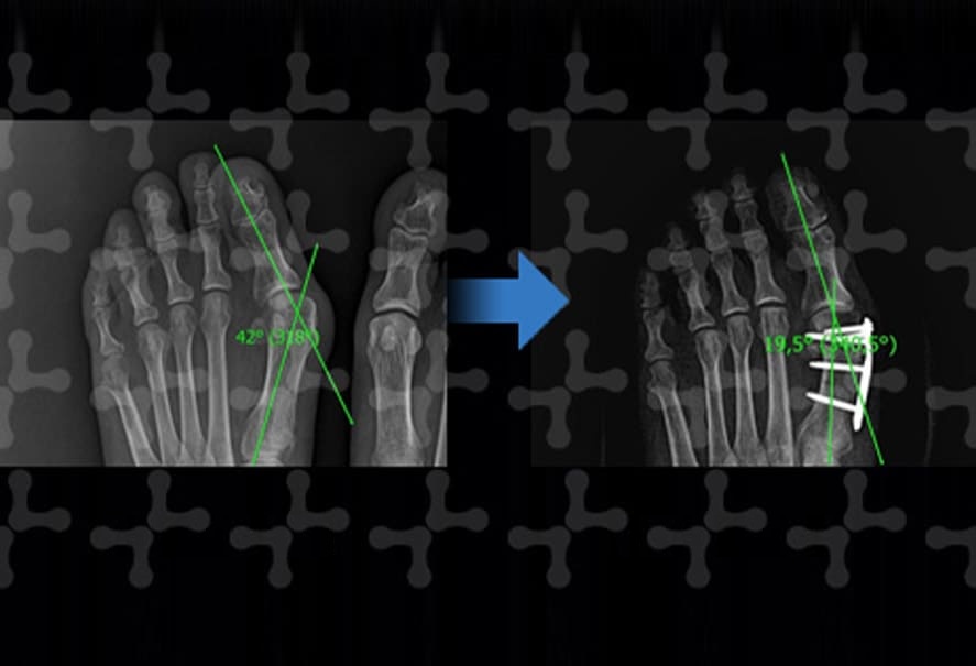 X-rays of hallux valgus before and after treatment