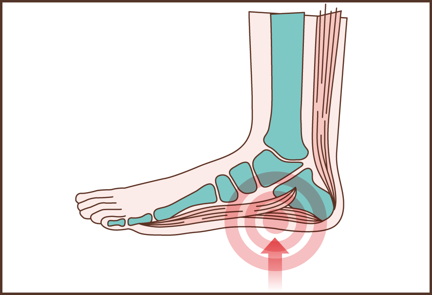 Illustration of the plantar fascia and heel pain