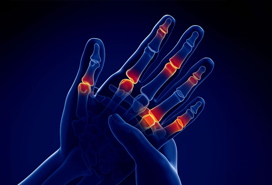 Illustration of inflamed finger joints