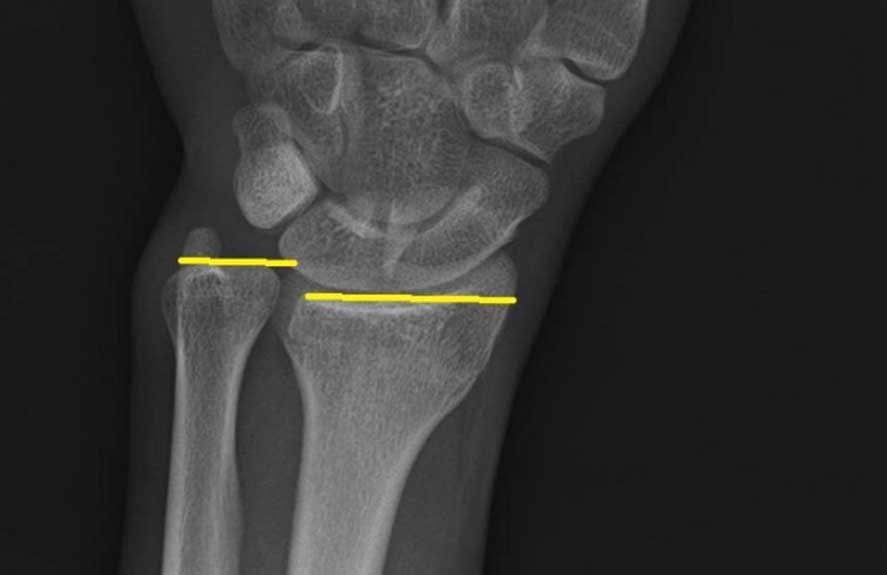 X-ray of the wrist