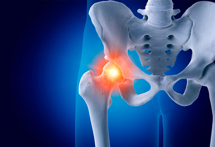 Illustration of a painful hip joint