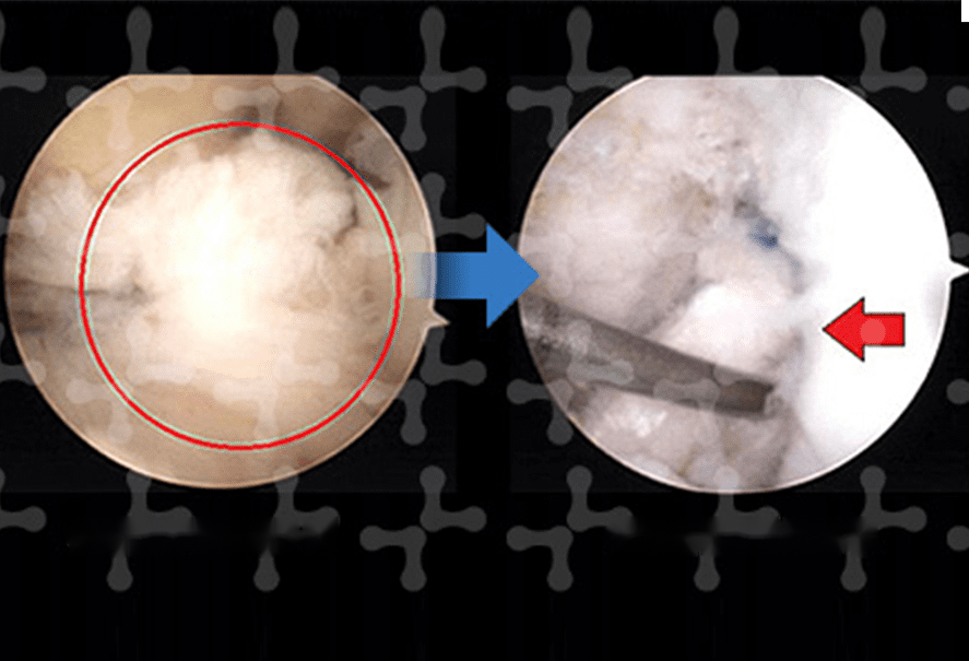 Arthroscopic views of a cruciate ligament tear before and after treatment