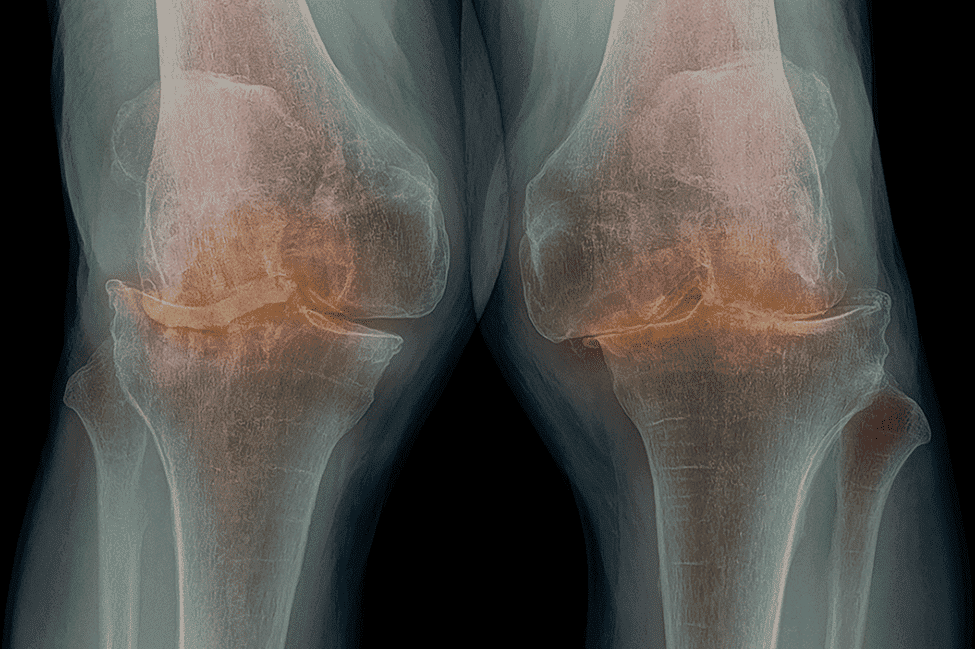Knee X-ray