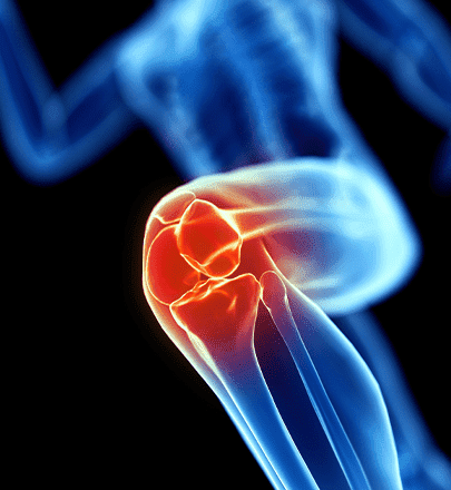Meniscus tear