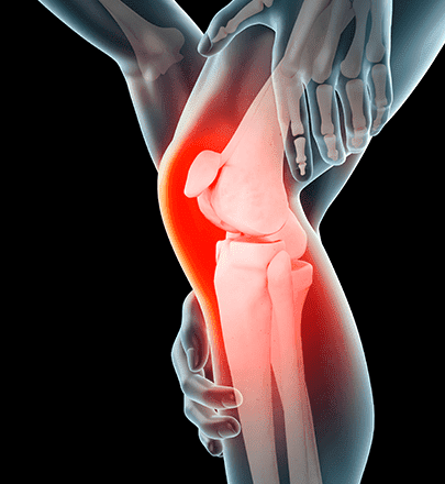 Chondromalacia patellae