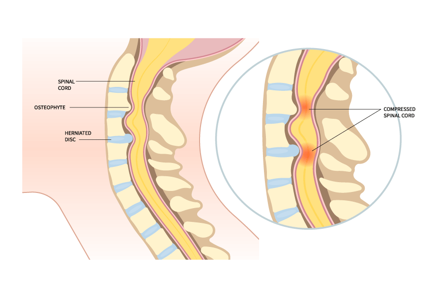 Illustration of a herniated cervical disc compressing the spinal cord