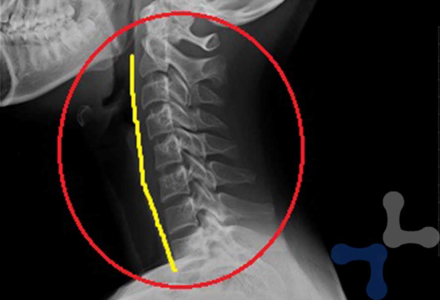 Side X-ray of a straightened cervical spine