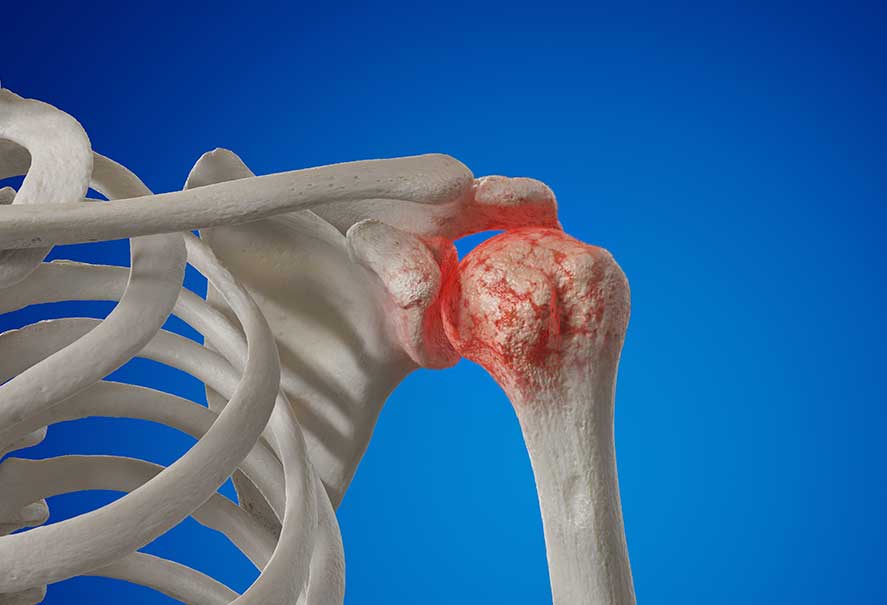 Illustration of an arthritic shoulder joint