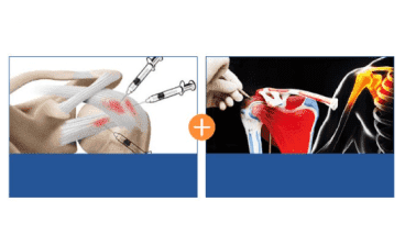 FIMS therapy combines prolotherapy and functional intramuscular stimulation