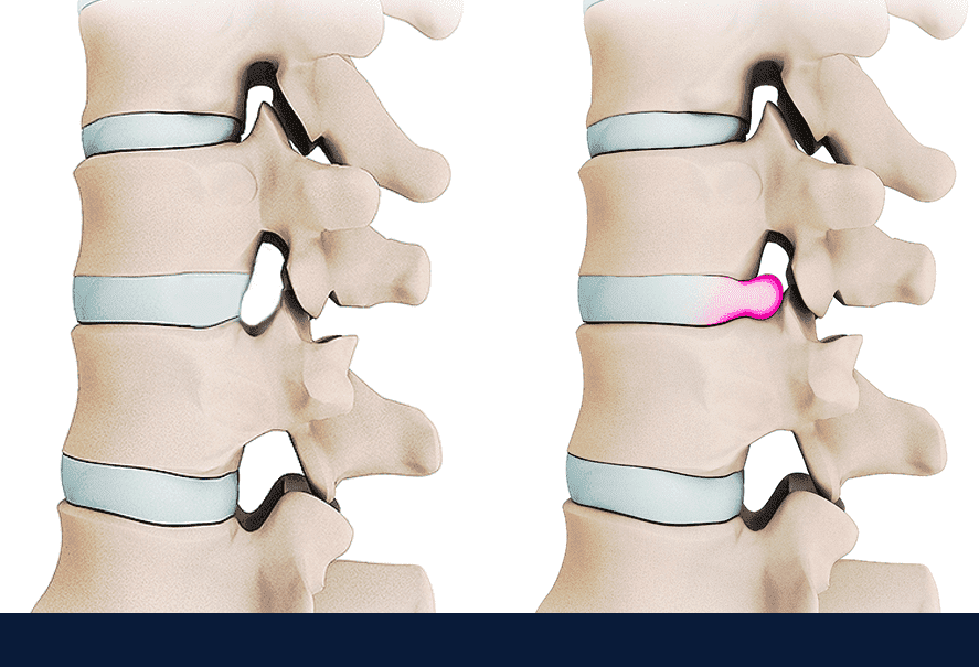 Comparison of a normal disc and a herniated disc